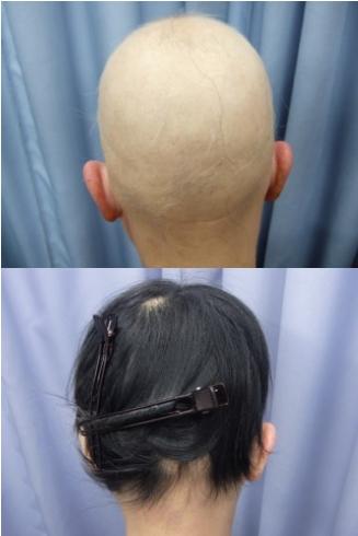 全頭型円形脱毛症(最重症型)の治療例